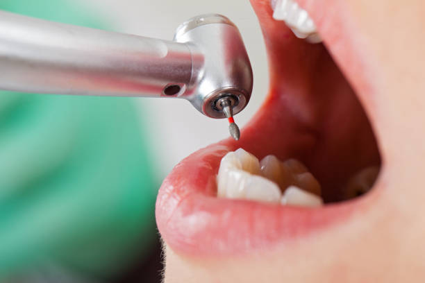 Best Emergency Wisdom Tooth Extraction in Akron, CO